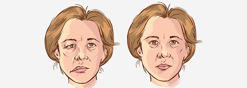 Paralisis facial tratamiento acupuntura malaga